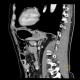Diverticulum of stomach: CT - Computed tomography